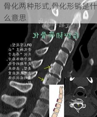 骨化两种形式,骨化形销是什么意思