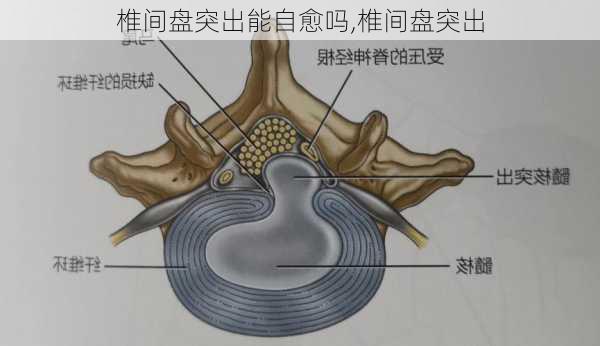 椎间盘突出能自愈吗,椎间盘突出