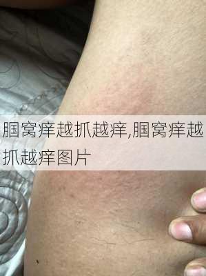 腘窝痒越抓越痒,腘窝痒越抓越痒图片