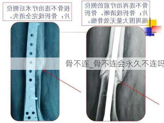 骨不连_骨不连会永久不连吗